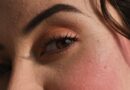 I Think I Have Rosacea. What Should I Do Now?